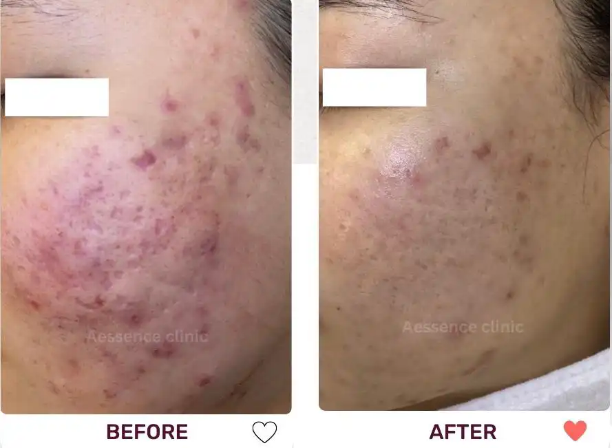 Before and after images showing the result of Acne Treatment