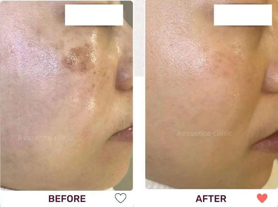 Before and after images showing blemishes on a person's face disappearing after going through pigmentation treatment