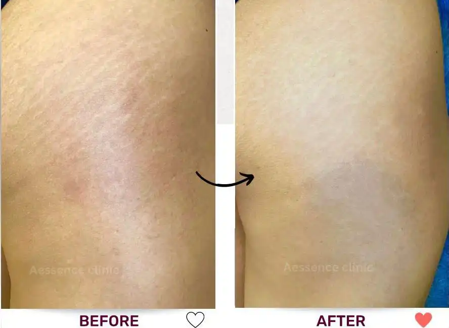 Before and after image comparison of the result of treating stretch marks