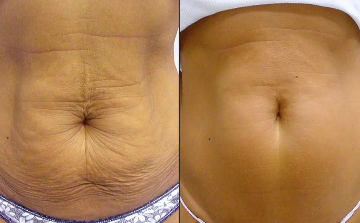 Before and after comparison of a wrinkled and fatty stomach turning more toned