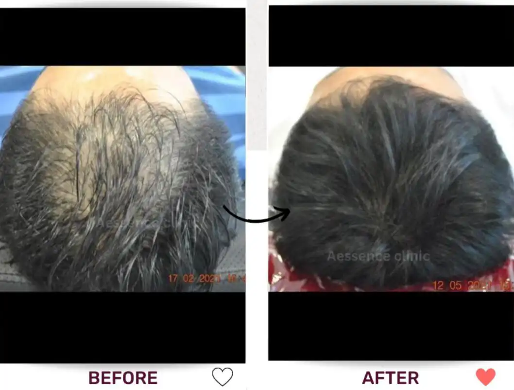 Before and after comparison images of a scalp of thin hair becoming a full head of hair