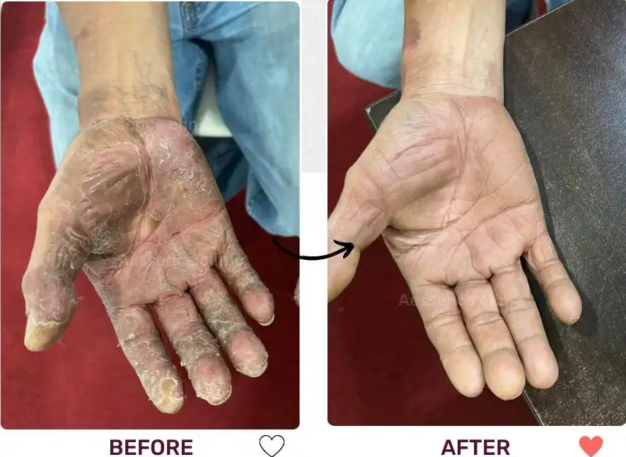 Before and after image showing a person's hand with eczema looking better after going through treatment