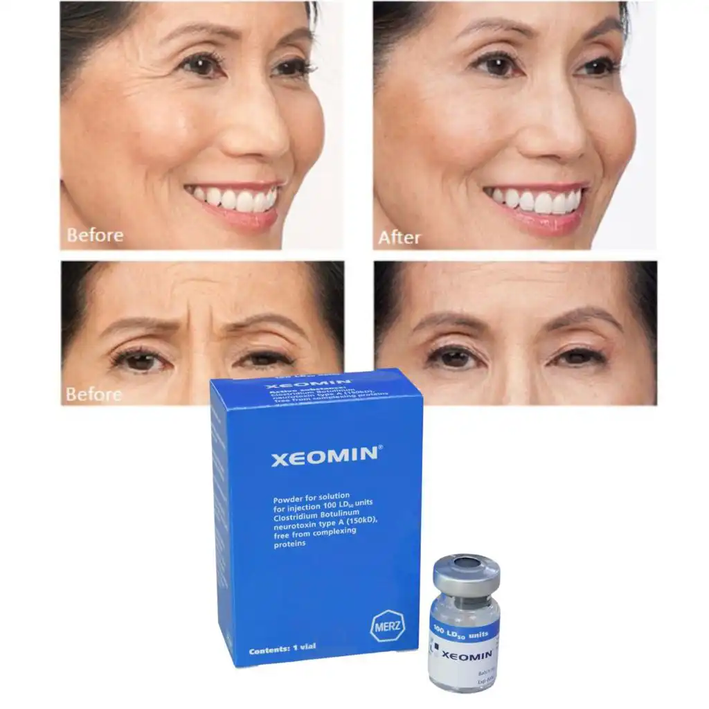 Before and after images of a woman's wrinkles disappearing after using Botulinum Toxin A injection