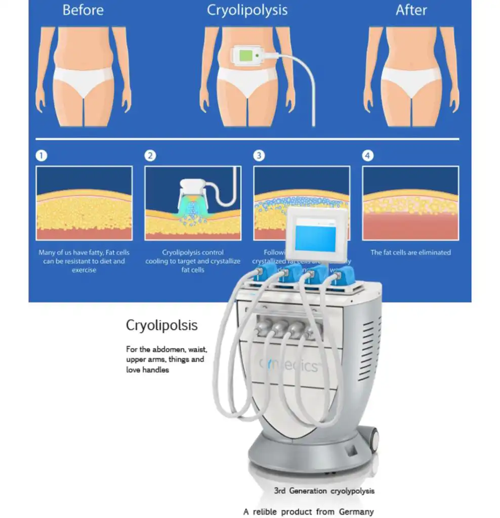 Before and after image of a chubby belly undergoing cryopolysis and becoming skinny