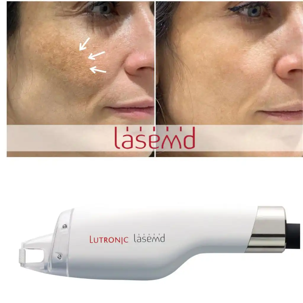 Before and after images showing the effect of LaseMD treatment removing skin blemishes and wrinkles from a woman's face