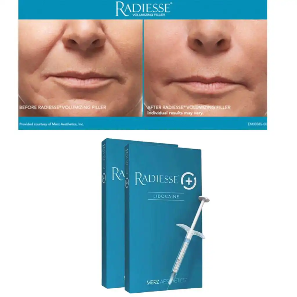 Before and after comparison of Radiesse treatment removing wrinkles and smoothening out a woman's face