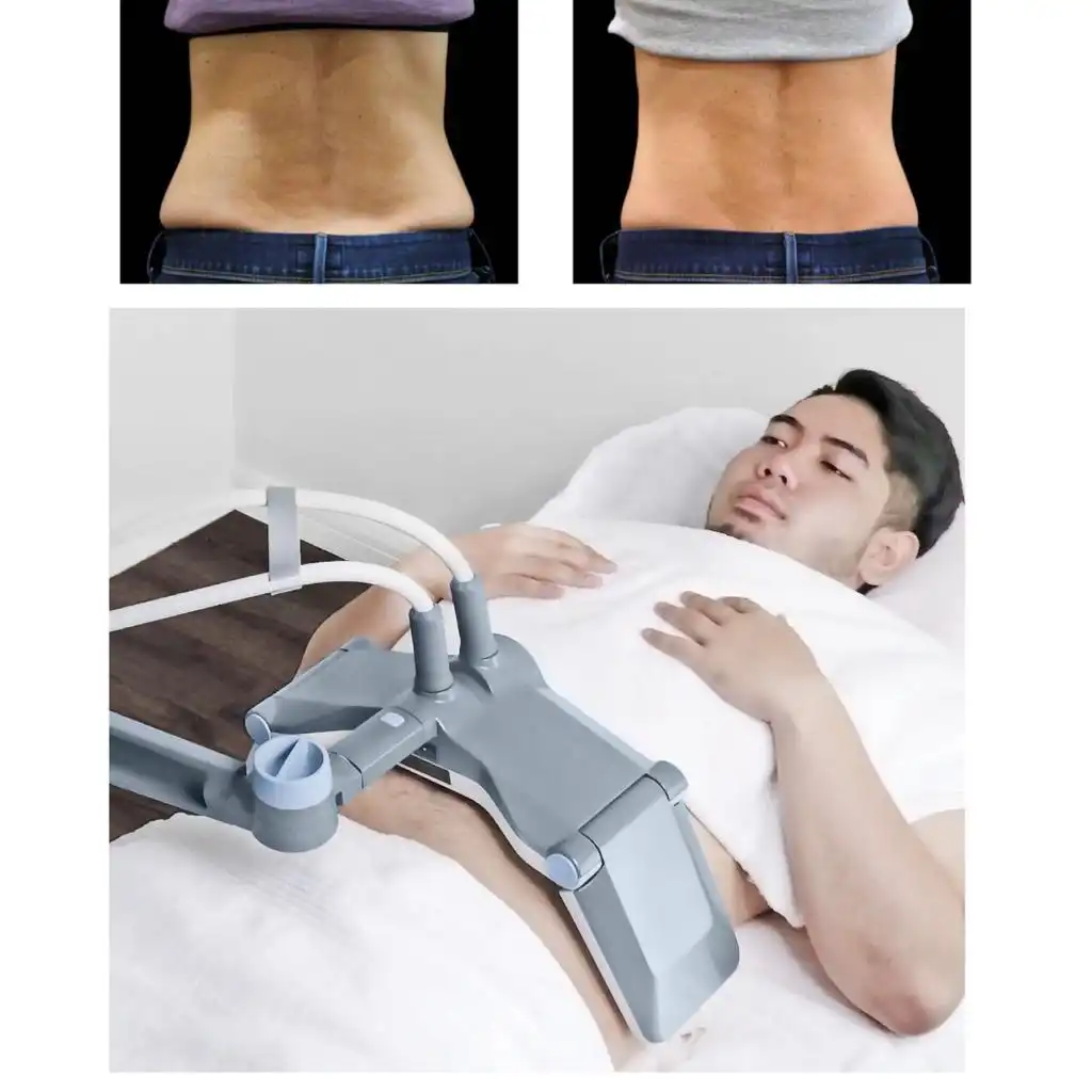 Before and after image of a man's torso before and after undergoing BTL Vanquish treatment, showing a more toned abdomen