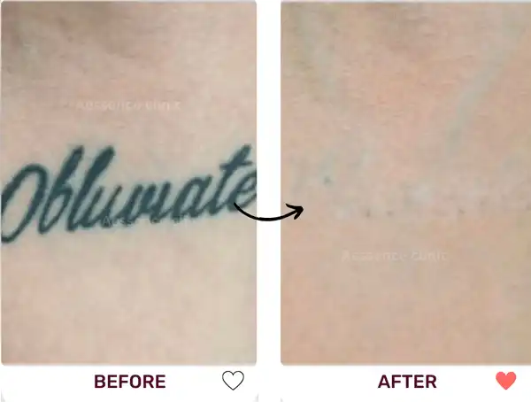 Before and after comparison of a tattoo being completely removed